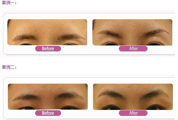 提眉術(shù)前后效果對(duì)比照片