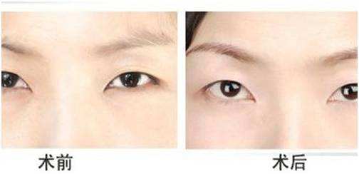 <a href=http://www.f3bb6.cn/listinfo-655-0.html target=_blank class=infotextkey>切眉</a>術后快速消腫的方法有哪些？