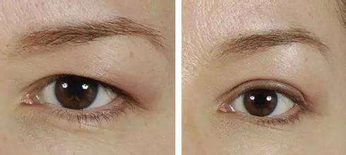 提眉術(shù)術(shù)前注意事項(xiàng)?