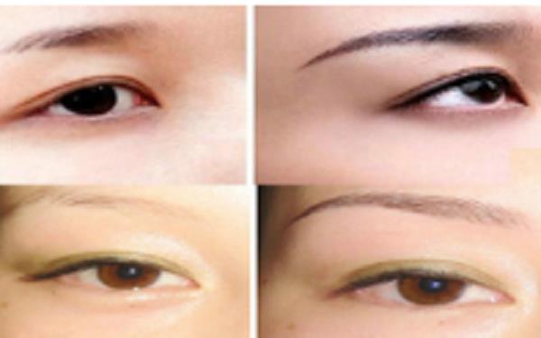 提眉術的手術方式有哪些?