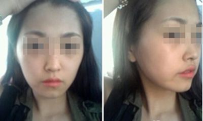 面部微調(diào)價格大致是多少