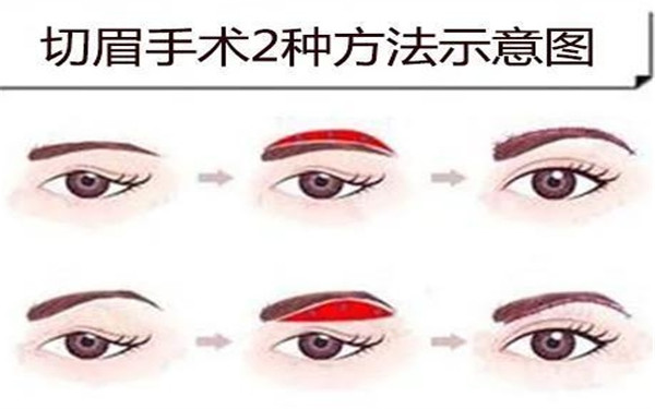 哪些人適合做<a href=http://www.f3bb6.cn/listinfo-655-0.html target=_blank class=infotextkey>切眉</a>術(shù)呢？