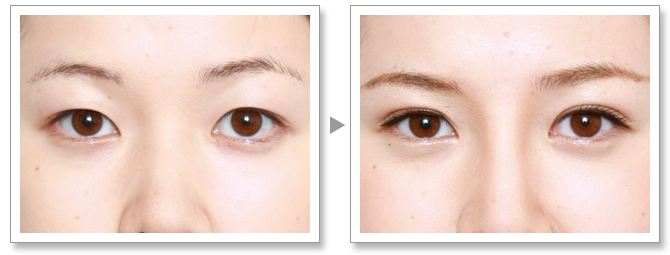 常見的<a href=http://www.f3bb6.cn/listinfo-655-0.html target=_blank class=infotextkey>切眉</a>術的方式有哪些呢？