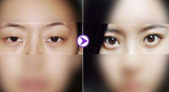 <a href=http://www.f3bb6.cn/listinfo-655-0.html target=_blank class=infotextkey>切眉</a>術(shù)有哪幾種方式及特點(diǎn)？