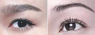 微創(chuàng)<a href=http://www.f3bb6.cn/listinfo-655-0.html target=_blank class=infotextkey>切眉</a>手術適合哪些人？