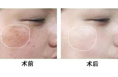 春季臉上黃褐斑怎么治療更好