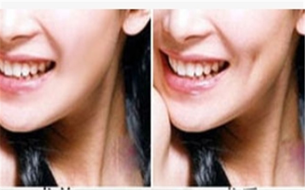 那么人造酒窩的方法具體有哪些呢?