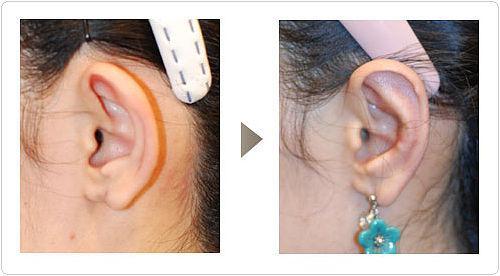 <a href=http://www.f3bb6.cn/listinfo-698-0.html target=_blank class=infotextkey>招風(fēng)耳矯正</a>是如何手術(shù)的呢