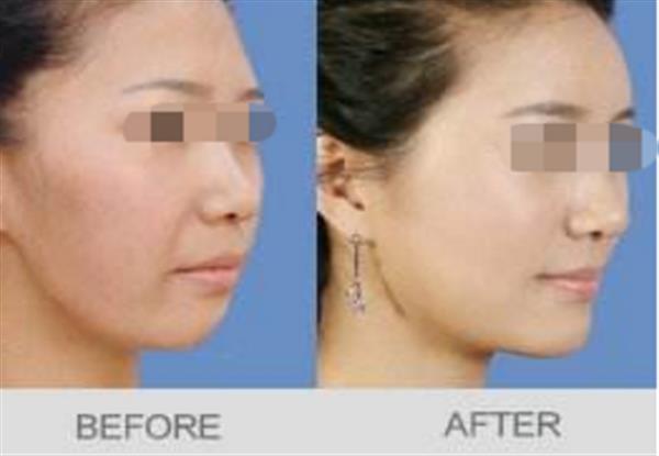 自體脂肪面部填充價格