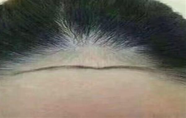 發際線怎么整形