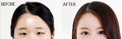 韓式重瞼術多少錢