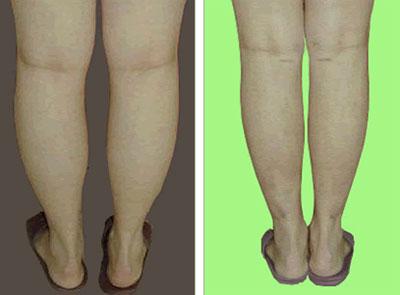 抽脂有什么危險(xiǎn)