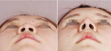 韓式<a href=http://www.f3bb6.cn/listinfo-737-0.html target=_blank class=infotextkey>隆鼻</a>真人前后對(duì)比