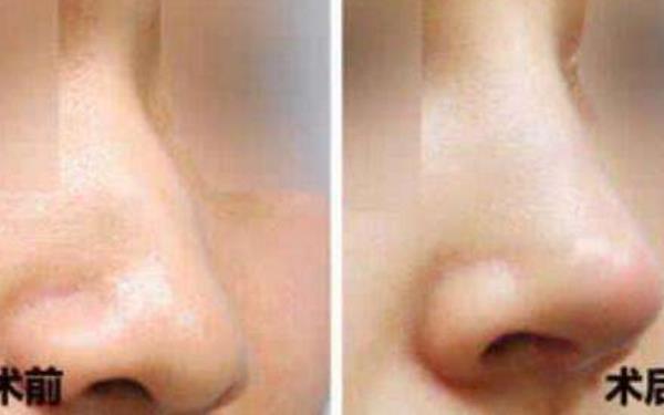 自體脂肪注射<a href=http://www.f3bb6.cn/listinfo-737-0.html target=_blank class=infotextkey>隆鼻</a>的注意事項