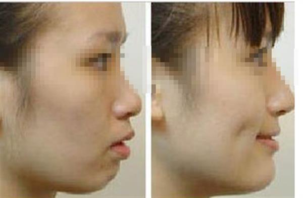 酒窩成形術(shù)后能終身受用嗎