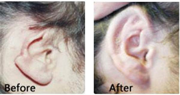 隱耳如何治療