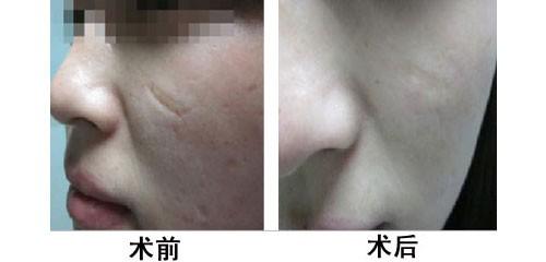 燙傷植皮有什么后遺癥