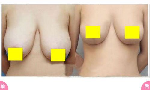 <a href=http://www.f3bb6.cn/listinfo-617-0.html target=_blank class=infotextkey>巨乳縮小</a>術(shù)的方法有那些