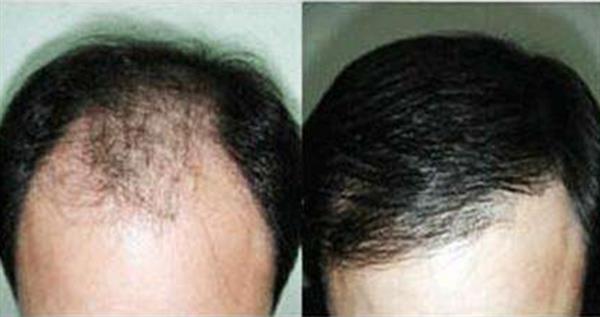 發(fā)際線整形圖片