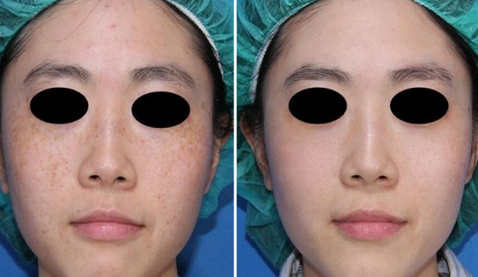 激光可以<a href=http://www.f3bb6.cn/listinfo-786-0.html target=_blank class=infotextkey>去黃褐斑</a>?