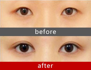 全切<a href=http://www.f3bb6.cn/listinfo-724-0.html target=_blank class=infotextkey>雙眼皮</a>恢復期需要多長時間