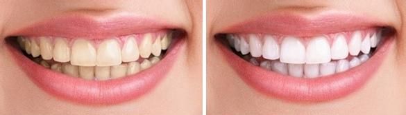 四環素牙是怎么產生的