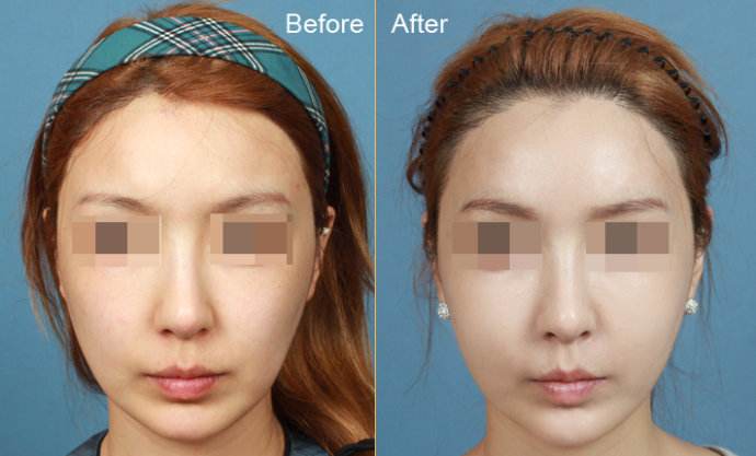 自體脂肪<a href=http://www.f3bb6.cn/listinfo-614-0.html target=_blank class=infotextkey>除皺</a>多少錢