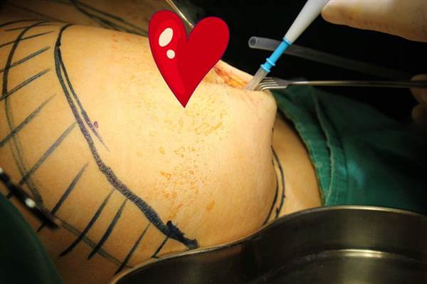 奧美定豐乳取出價格