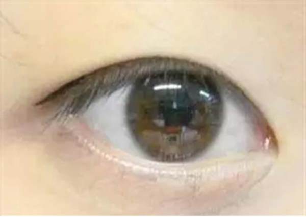 熱效<a href=http://www.f3bb6.cn/listinfo-682-0.html target=_blank class=infotextkey>溶脂</a><a href=http://www.f3bb6.cn/listinfo-708-0.html target=_blank class=infotextkey>去眼袋</a>后凹陷怎么治療