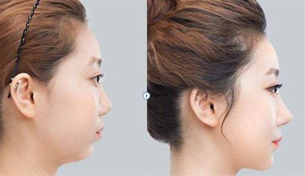 <a href=http://www.f3bb6.cn/listinfo-737-0.html target=_blank class=infotextkey>隆鼻</a>大概需要多少錢