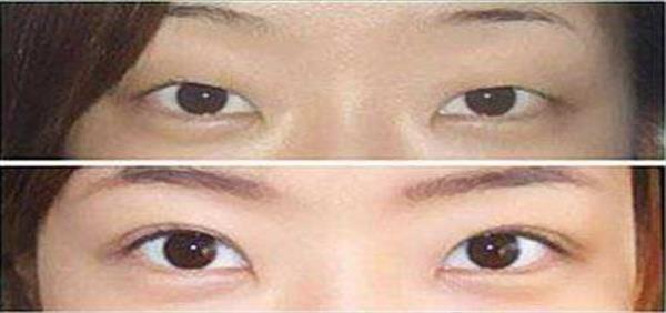 一般割<a href=http://www.f3bb6.cn/listinfo-724-0.html target=_blank class=infotextkey>雙眼皮</a>的價格