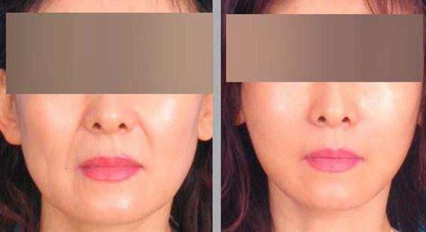 3大<a href=http://www.f3bb6.cn/listinfo-614-0.html target=_blank class=infotextkey>除皺</a>術(shù)效果怎么樣