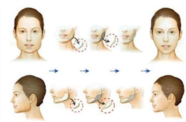 做<a href=http://www.f3bb6.cn/listinfo-629-0.html target=_blank class=infotextkey>下頜角</a>矯正要價格