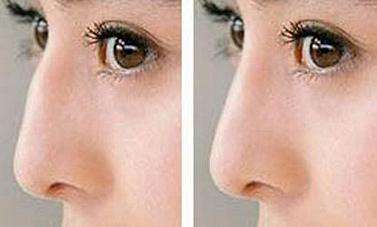 <a href=http://www.f3bb6.cn/listinfo-756-0.html target=_blank class=infotextkey>驼峰鼻矫正</a>的术后护理