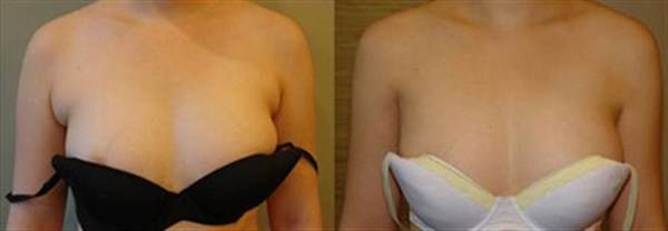 副乳切除多少錢