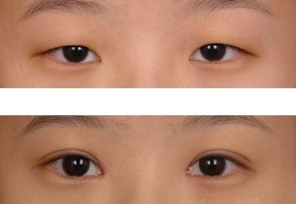 選擇<a href=http://www.f3bb6.cn/listinfo-717-0.html target=_blank class=infotextkey>上瞼下垂矯正</a>術(shù)的優(yōu)點(diǎn)
