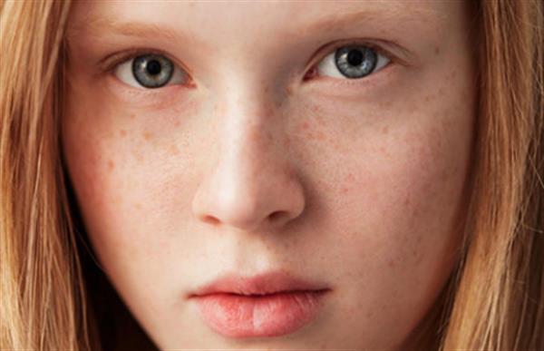 去除日曬斑術(shù)后注意事項(xiàng)