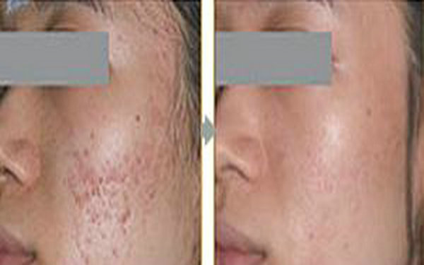 磨削術去凹坑多少錢?