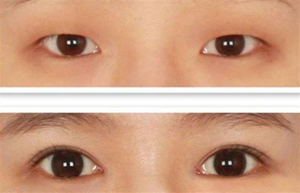 割<a href=http://www.f3bb6.cn/listinfo-724-0.html target=_blank class=infotextkey>雙眼皮</a>幾個(gè)月定型