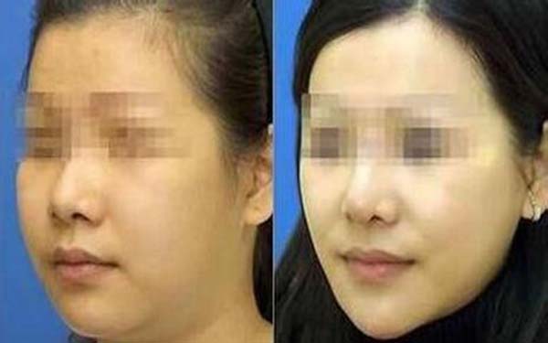 打一次<a href=http://www.f3bb6.cn/listinfo-631-0.html target=_blank class=infotextkey>瘦臉</a><a href=http://www.f3bb6.cn/listinfo-614-0.html target=_blank class=infotextkey>除皺</a>會反彈嗎