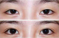 有關切開<a href=http://www.f3bb6.cn/listinfo-724-0.html target=_blank class=infotextkey>雙眼皮</a>的術前準備