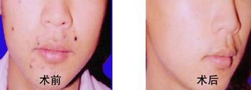 點陣激光幾天可以洗臉