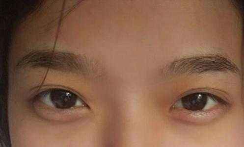 透明質(zhì)酸做<a href=http://www.f3bb6.cn/listinfo-722-0.html target=_blank class=infotextkey>臥蠶</a>手術效果怎么樣