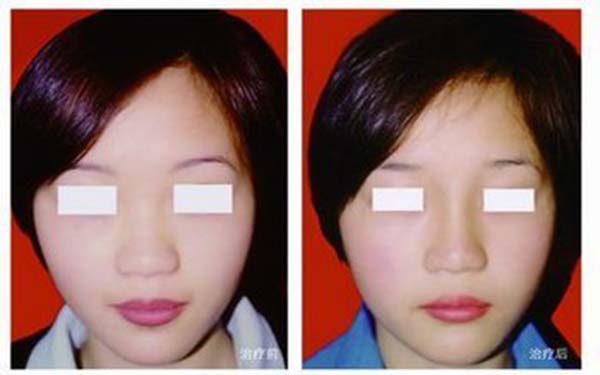 怎么<a href=http://www.f3bb6.cn/listinfo-631-0.html target=_blank class=infotextkey>瘦臉</a>瘦雙下巴