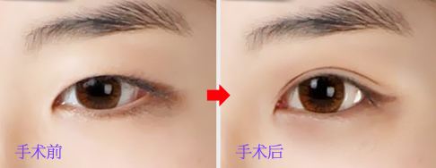 <a href=http://www.f3bb6.cn/listinfo-724-0.html target=_blank class=infotextkey>雙眼皮</a>埋線法可保幾年