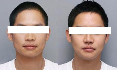 下頜骨削骨手術(shù)價格