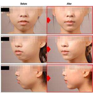 自體脂肪填下巴成活率