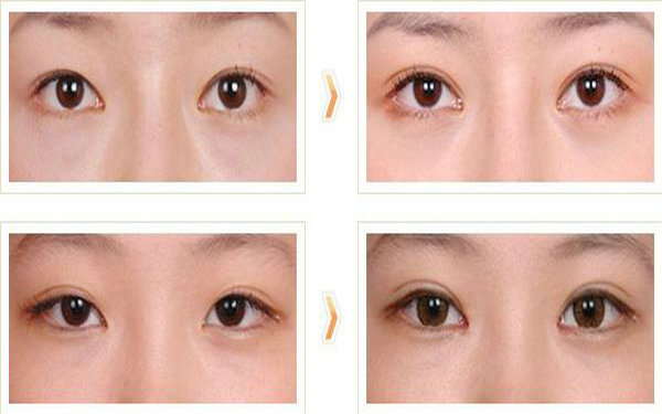 哪些人不適合做<a href=http://www.f3bb6.cn/listinfo-724-0.html target=_blank class=infotextkey>雙眼皮</a>?