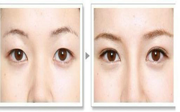 哪種<a href=http://www.f3bb6.cn/listinfo-724-0.html target=_blank class=infotextkey>雙眼皮</a>手術較好?