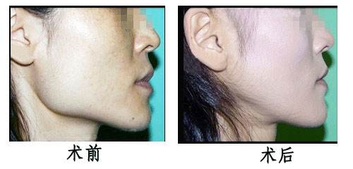 長期去除咬肌注意事項